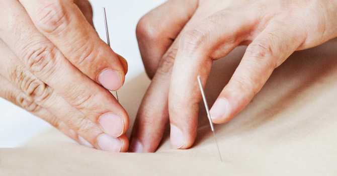 Dry Needling