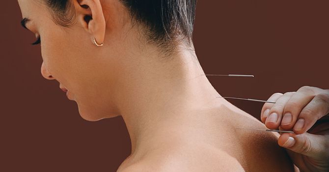 Cupping Therapy